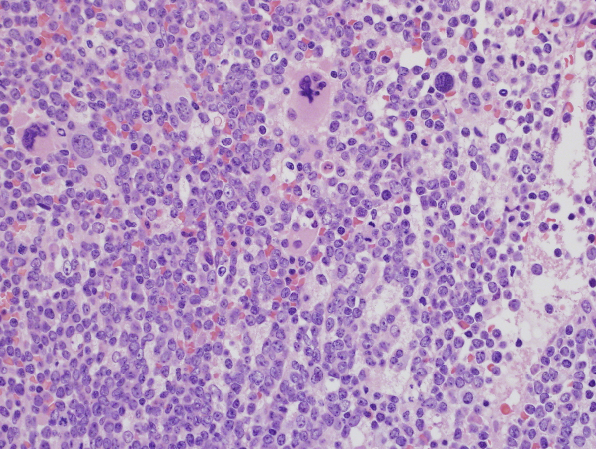 Bone Marrow Biopsy, H & E, 40X